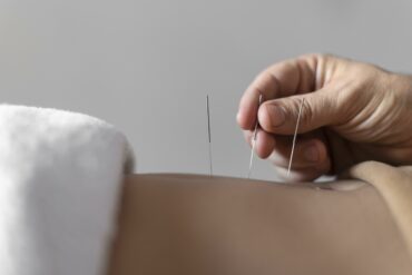 Quali sono gli effetti collaterali dell’agopuntura